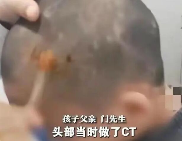 冷水泡脚 热水烫头男童虐待