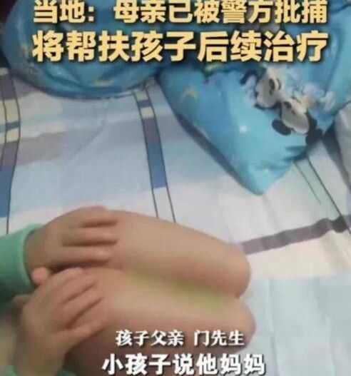 孩子接受了双侧小腿的截断手术